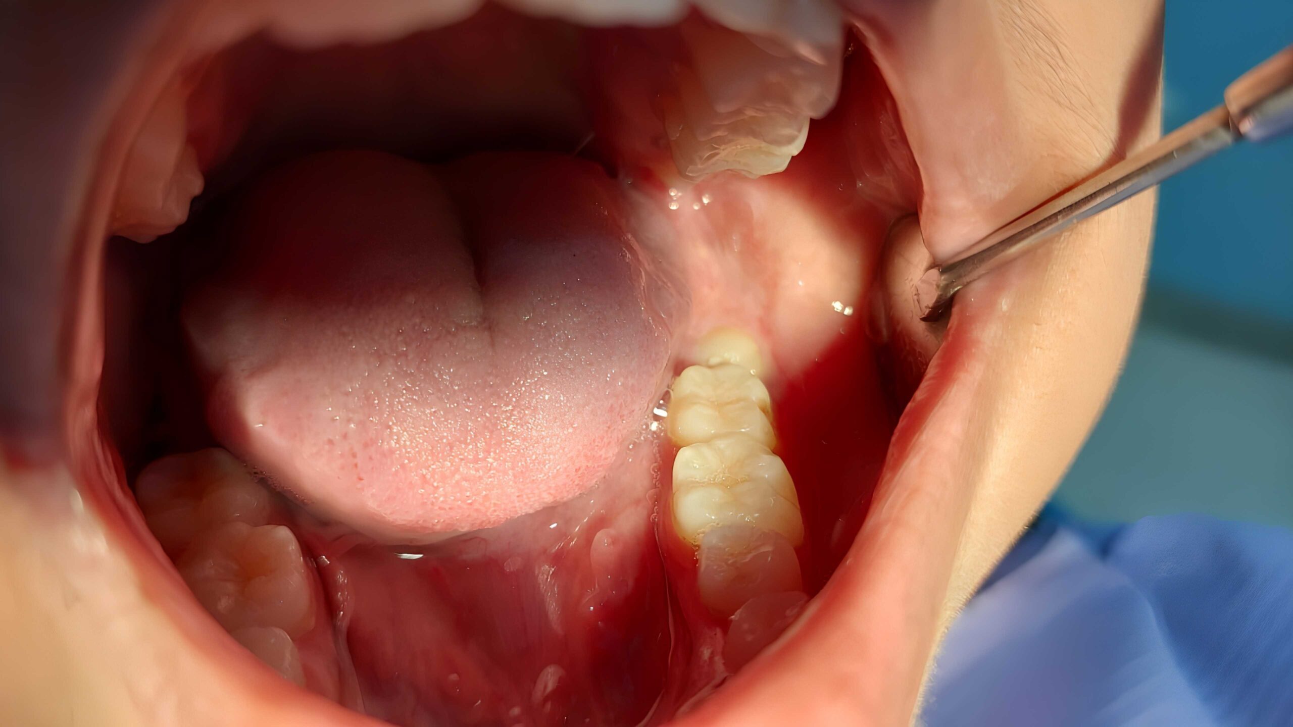 Intraoral clinical view of a wisdom tooth during a dental examination at our Costa Mesa office