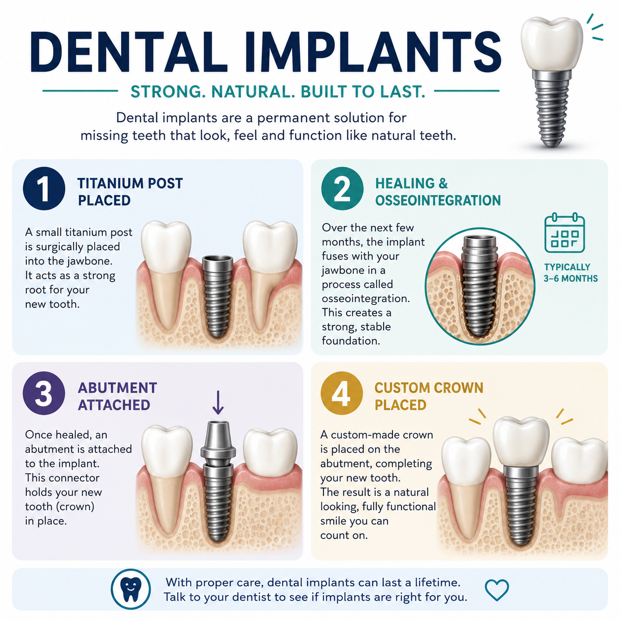 Infographic showing the four stages of a dental implant: titanium post placement, healing and osseointegration, abutment attachment, and custom crown placement