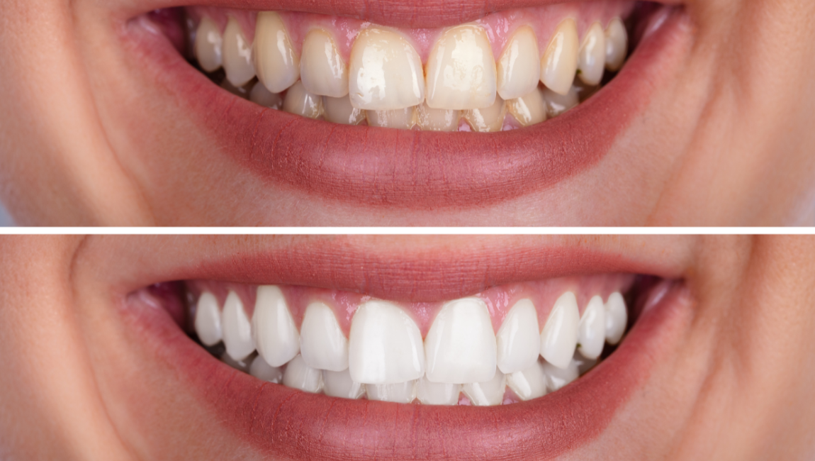 Before and after comparison showing teeth lifted several shades brighter after professional Zoom whitening