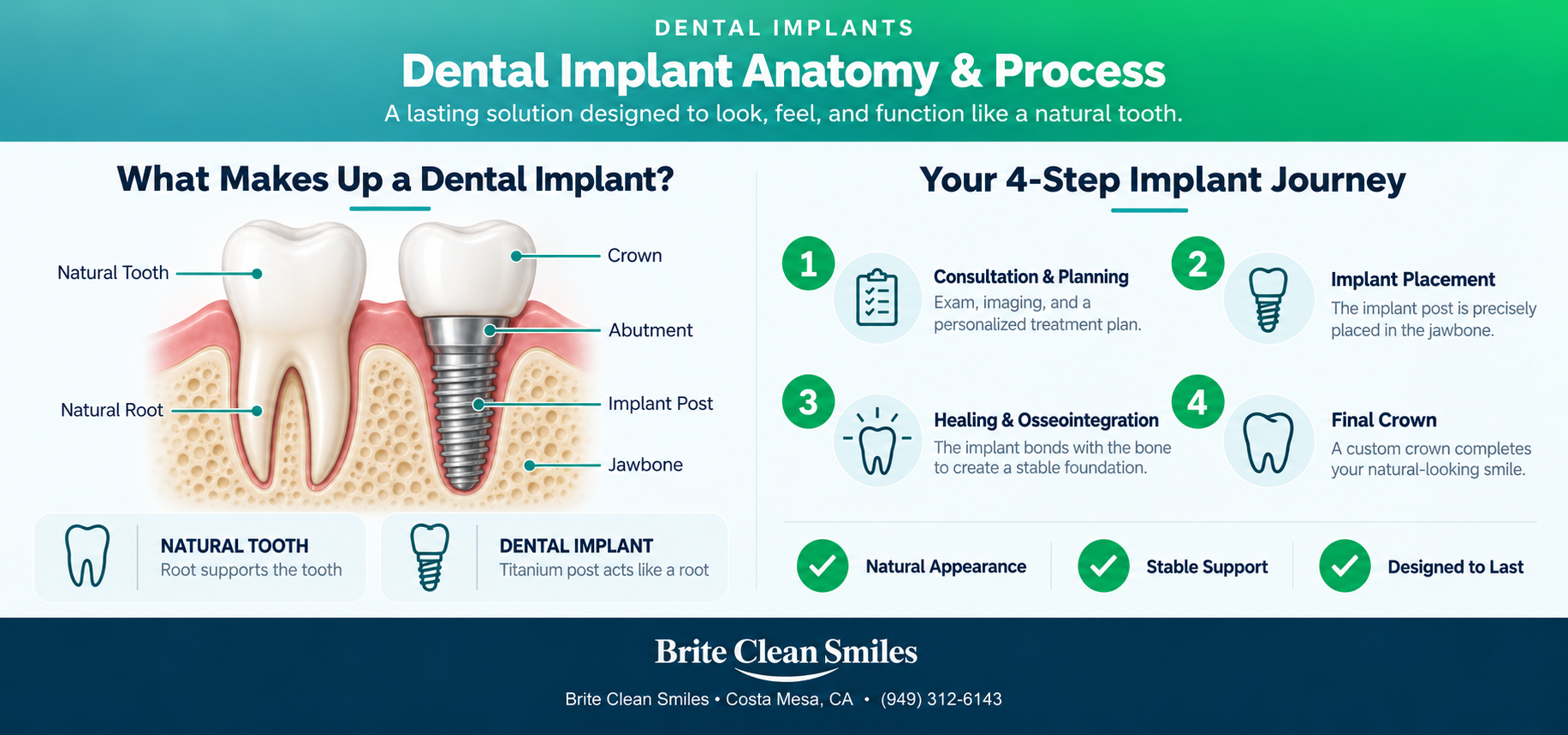 Infographic showing dental implant anatomy compared to a natural tooth, with the crown, abutment, implant post and jawbone labeled, plus the 4-step implant journey from consultation and placement to healing and final crown